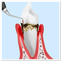歯周病のしくみ